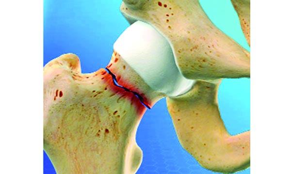 ওমেপ্রাজল সেবনে বাড়ে হিপ ফ্রাকচার
