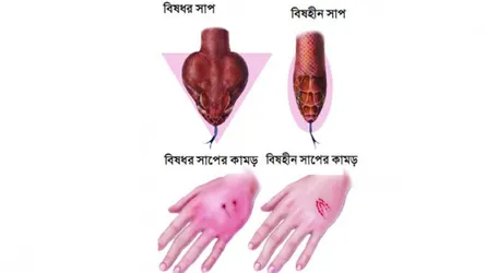 সর্পদংশনে প্রাথমিক  চিকিৎসা