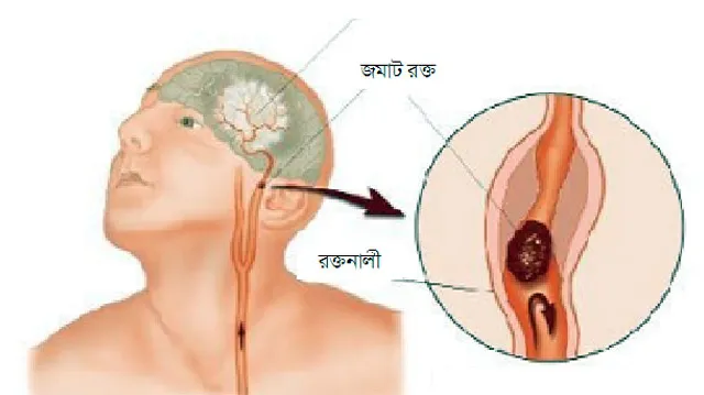 ছোটদের স্ট্রোক