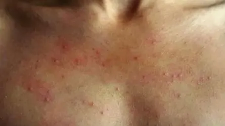বিরল র‌্যাশ
