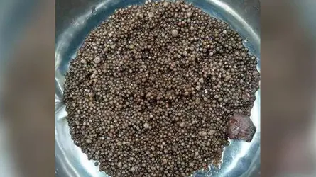 পিঠে ব্যাথা : কিডনিতে পাওয়া গেল ৩ হাজার পাথর