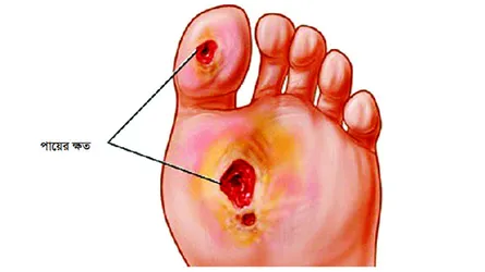 ডায়াবেটিস রোগীর  পায়ের যতœ