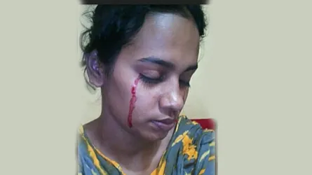 বিরল রোগে আক্রান্ত মোহাজেরিনের চোখ দিয়ে রক্ত ঝরে