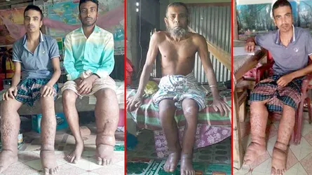 বিরল রোগে মৃত্যুযন্ত্রণায় ছটফট করছে একই পরিবারের ৫ জন