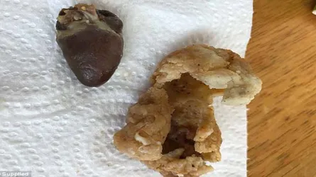 কেএফসির ফাস্ট ফুডে ‘কাঁচা মুরগির হৃৎপিণ্ড’