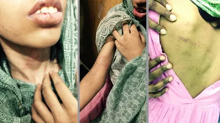মেয়েটির সারা শরীরে আঘাতের চিহ্ন