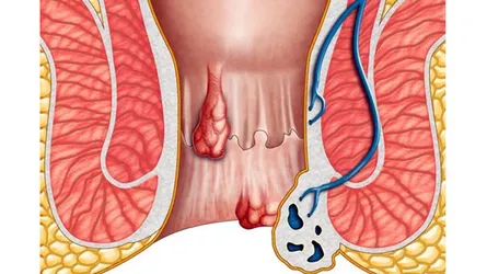 পাইলস-ফিসার : কেন হয়, কী করবেন