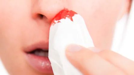 নাক দিয়ে কেন রক্ত পড়ে?
