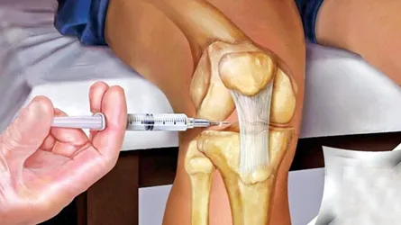 চিকিৎসায় কি আর্থ্রাইটিস বা বাতরোগ সারে?