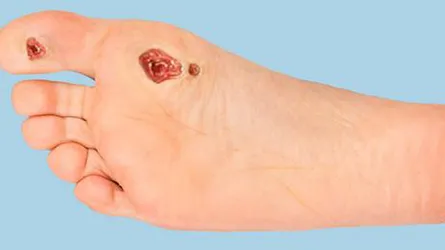 ডায়াবেটিক রোগীর পায়ের যত্ন
