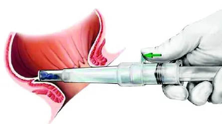 পাইলস  চিকিৎসায়  লংগো  অপারেশন