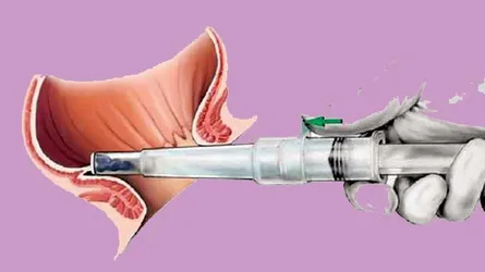 পাইলস চিকিৎসায় লংগো অপারেশন