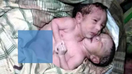 নওগাঁর মান্দায় জোড়া লাগানো জমজ শিশুর জন্ম