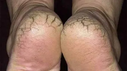 শীতে পা ফেটে গেছে! কী করবেন!