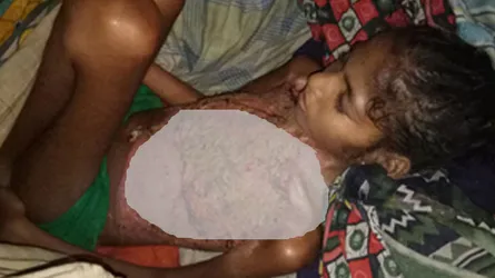 দগ্ধ শিশু গৃহপরিচারিকা মিনার শরীরে পঁচন ধরেছে