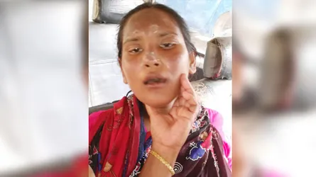 জ্বীন তাড়ানোর নামে আগুনে ঝলসে দেয়া হলো গৃহবধূর মুখ!