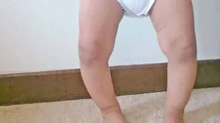 শিশুর রিকেটস