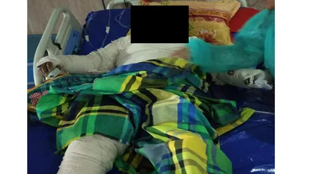 শ্রীনগরে নির্যাতনের শিকার গৃহবধূ ঢামেক বার্ণ ইউনিটে মৃত্যুর সাথে পাঞ্জা লড়ছে