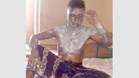 গরম তেল ঢেলে স্বামীর শরীর ঝলসে দিল স্ত্রী