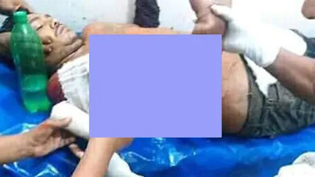বাসচাপায় ছাত্রদল নেতার হাত বিচ্ছিন্ন