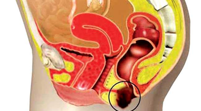 কী কী কারণে হতে পারে পায়ুপথে ব্যথা