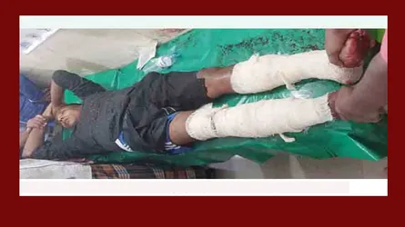 হাতুড়িপেটা করে আ’লীগ নেতার দুই পা ভেঙ্গে দিয়েছে সন্ত্রাসীরা