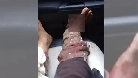 মাদক ব্যাবসায়ীর পা কেটে নিয়েছে সন্ত্রাসীরা
