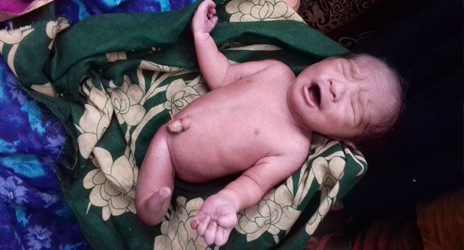 সিরাজগঞ্জে এক পা ওয়ালা অদ্ভুত শিশুর জন্ম