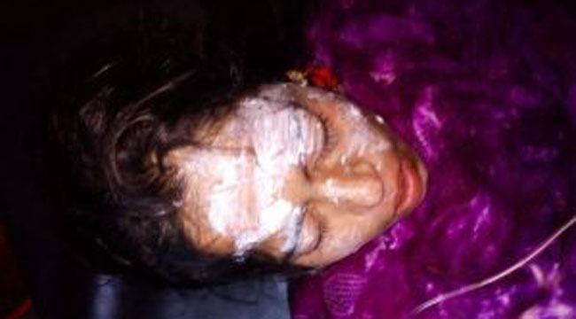 সাতক্ষীরায় তালাক দেয়া স্বামী এসিডে ঝলসে দিলো স্ত্রী-কন্যাকে