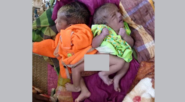 বড়াইগ্রামে জোড়ালাগা জমজ শিশুর জন্ম