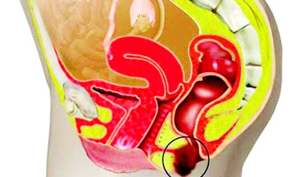 পায়ুপথে ব্যথার কারণ ও প্রতিকার