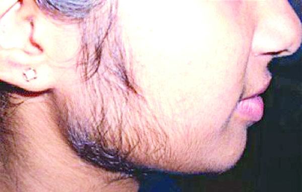মেয়েদের  মুখে  অবাঞ্ছিত  লোম