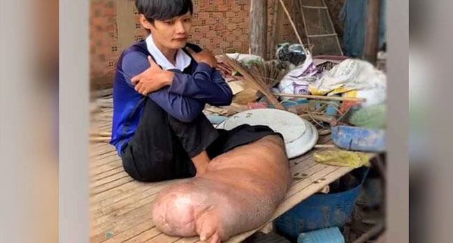 মশার এক কামড়েই তছনছ এই ব্যক্তির জীবন