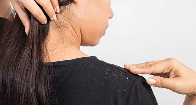 ঘরোয়া পদ্ধতিতে খুশকি সমস্যার সমাধান