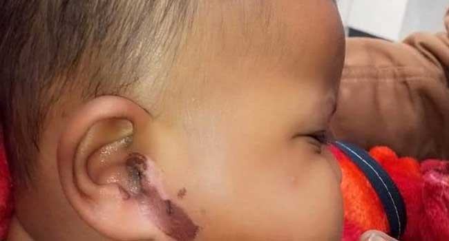 কাপাসিয়ায় শিশুর কানে ও যৌনাঙ্গে এসিড ঢেলে দেয়ার অভিযোগ
