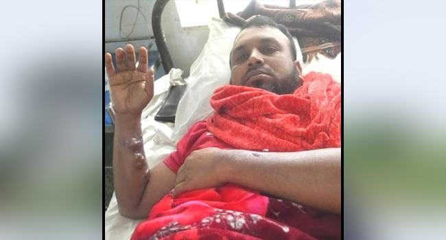 সাংবাদিক কন্যাকে উত্ত্যক্ত, গরম পানিতে ঝলসালো বাবাকে
