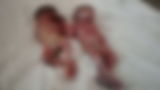 কিশোরগঞ্জে লাঠির আঘাতে গর্ভপাত, ২ জমজ সন্তান প্রসব
