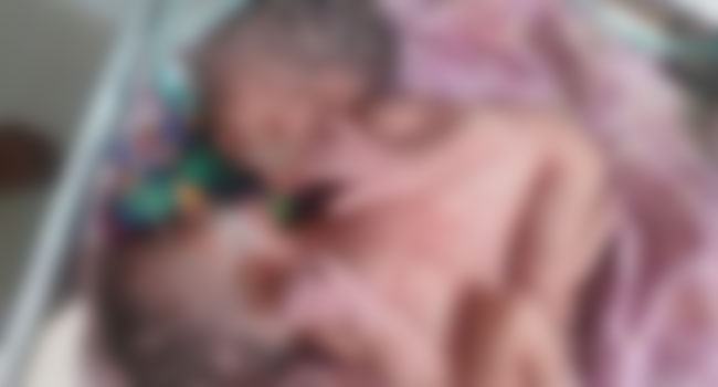 মারা গেলো জোড়া লেগে জন্ম নেয়া সেই দুই শিশু