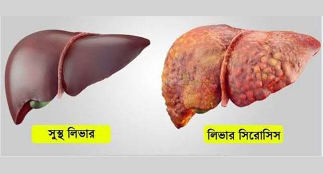 লিভার সিরোসিস ও বাংলাদেশে এ রোগের চিকিৎসা ব্যবস্থা