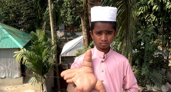 শিশু রেহানের আঙ্গুল-ফোলা রোগ, অনিশ্চিত ভবিষ্যত নিয়ে দুঃশ্চিন্তায় বাবা-মা