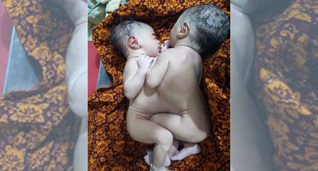 ভোলায় পেটে জোড়া লাগানো যমজ শিশুর জন্ম, ‘আলাদা করা যাবে তাদের’