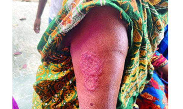 গুরুদাসপুরে অজ্ঞাত রোগে আক্রান্ত এক গ্রামের ৬০ জন