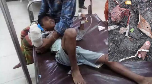 খেলতে গিয়ে কুড়িয়ে পাওয়া বলের বিস্ফোরণ, কব্জি উড়ে গেল শিশুর