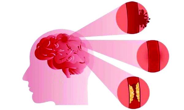 স্ট্রোক হলে কোথায় যাবেন?