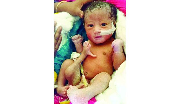 মিরসরাইয়ে চার পা বিশিষ্ট শিশুর জন্ম
