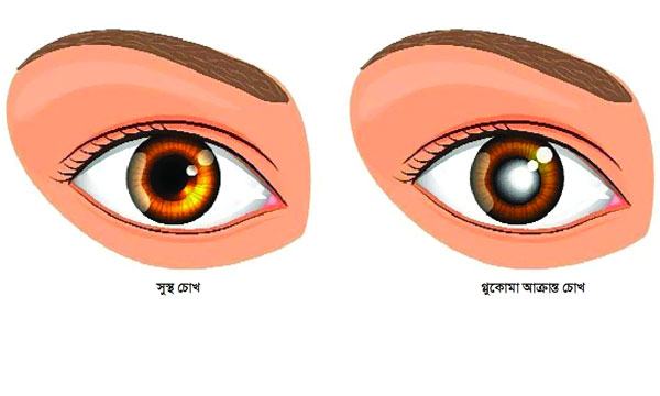 গ্লুকোমা নিয়ে এত ভয় কেন
