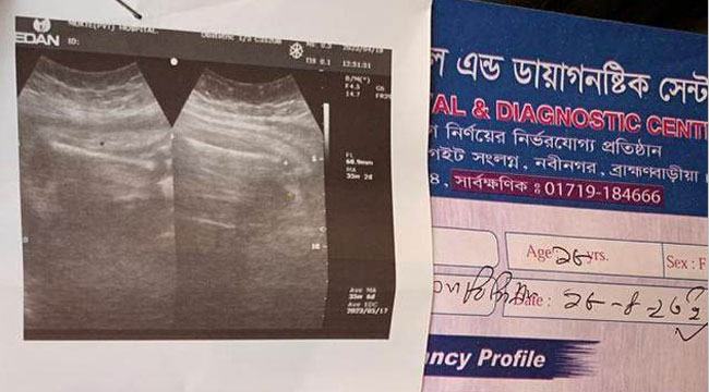 আলট্রাসনোগ্রাফিতে যমজ শিশু, জন্ম ১ জনের