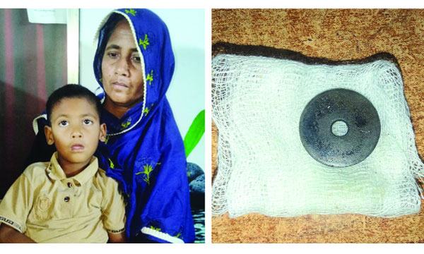 ১৩ দিন পর জানা গেল শিশুর গলায় আটকে আছে লোহার ওয়াশার