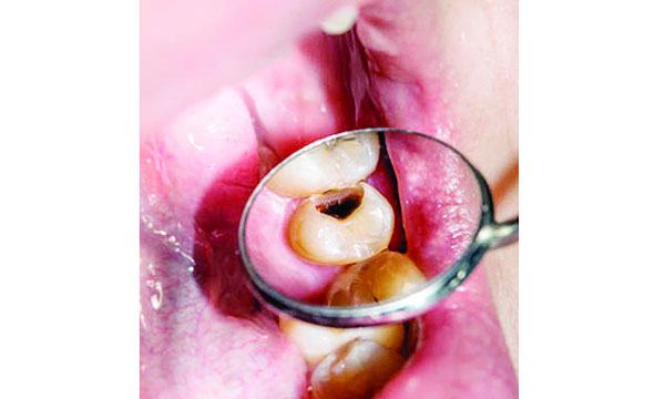 দাঁতে ক্যাভিটির কারণ ও প্রতিরোধ