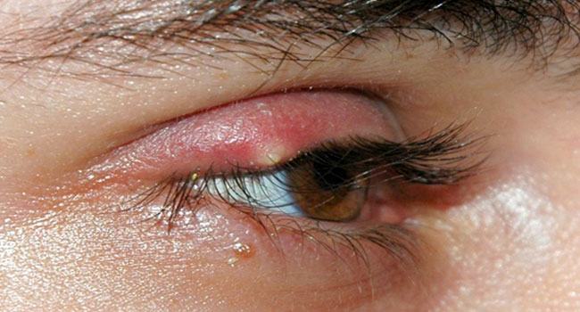 চোখের পাতায় কি ফোঁড়া হতে পারে?